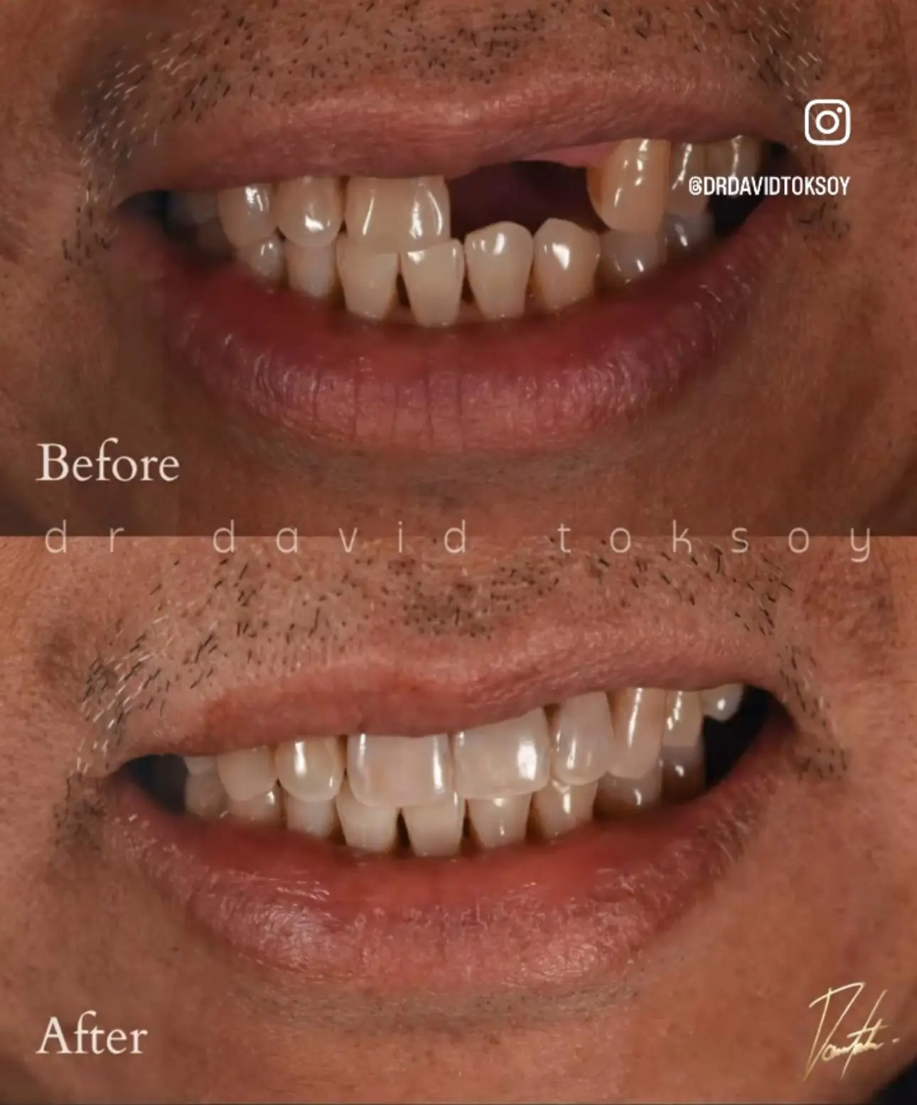 Before and after smile showing dental restoration with natural-looking teeth, tagged @drdavidtoksoy